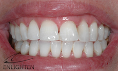 enlighten teeth whitening