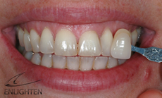 enlighten teeth whitening