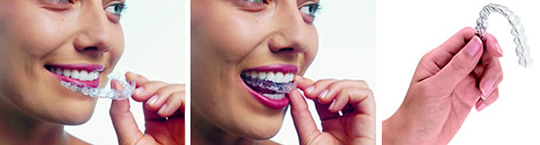 Invisalign All