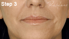 Step 3 of the Restylane treatment