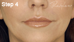 Step 4 of the Restylane treatment
