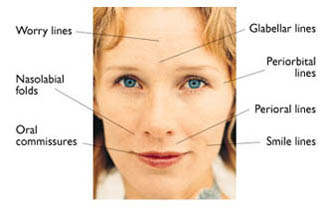 Restylane