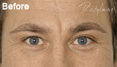 Glabellar lines before Restylane treatment