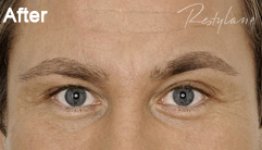 Glabellar lines after Restylane treatment