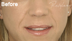 Nasolabial folds before Restylane treatment