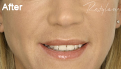 Nasolabial folds after Restylane treatment
