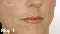 Step 1 of the Restylane treatment