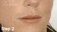 Step 2 of the Restylane treatment