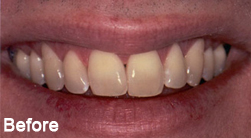 Step 1 of the Restylane treatment