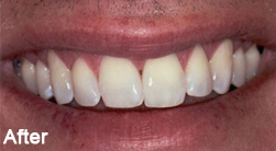 Step 2 of the Restylane treatment